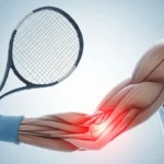 테니스 엘보 완화에 도움 된 스포츠 마사지